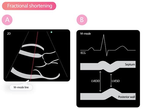 fractional shortening calculator.